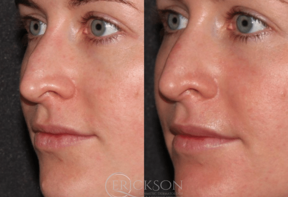 CO Nose before + after results CO Nose before + after results