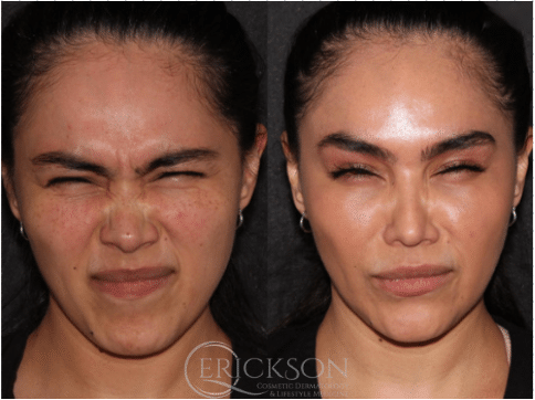 Daxxify before + after results