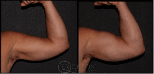 Emsculpt Biceps before + after results Emsculpt Biceps before + after results