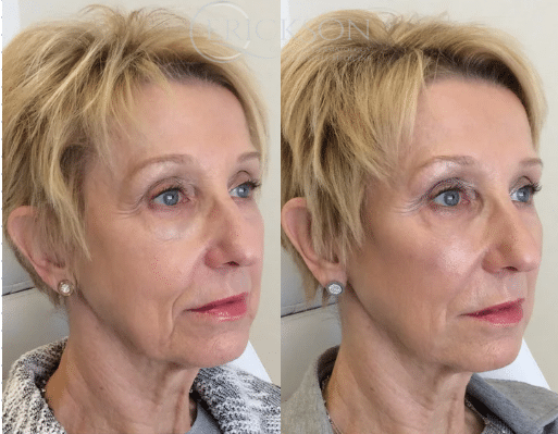 Facial Filler Original before + after results Facial Filler Original before + after results