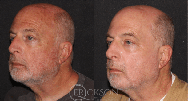 Laser Resurfacing before + after results Laser Resurfacing before + after results