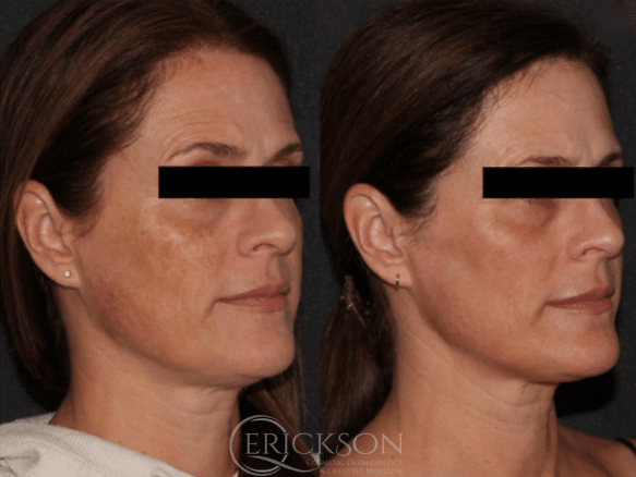 MOXI Face before + after results MOXI Face before + after results