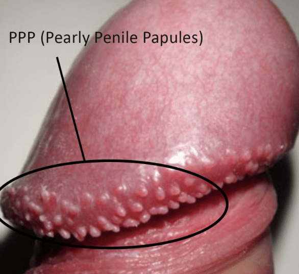 Close-up of pearly penile papules (PPP) before treatment
