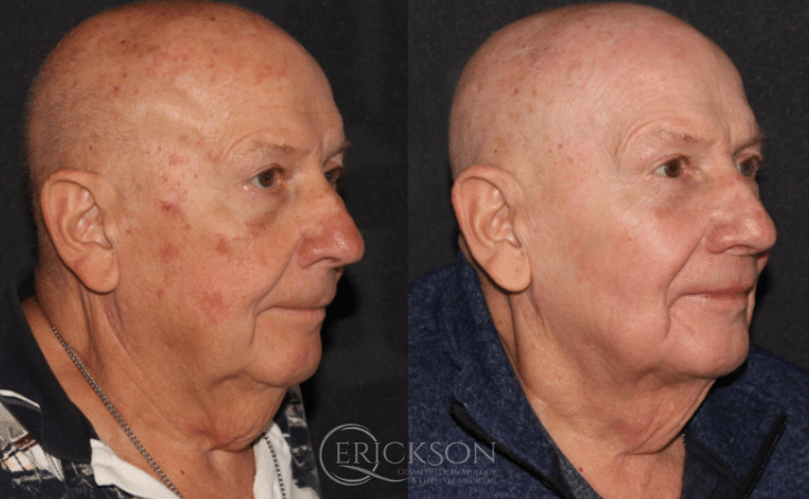 Profrac before + after results Profrac before + after results