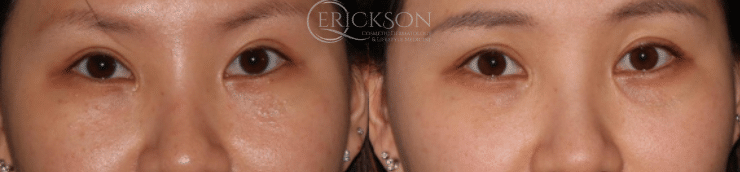 Resurfx Under Eye before + after results Resurfx Under Eye before + after results