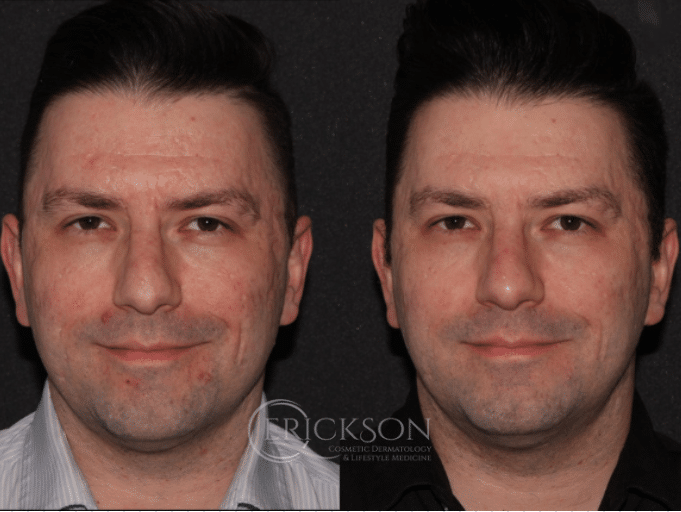 Botox Before and After Photo by Dr. Erickson in Chicago, IL Botox Before and After Photo by Dr. Erickson in Chicago, IL