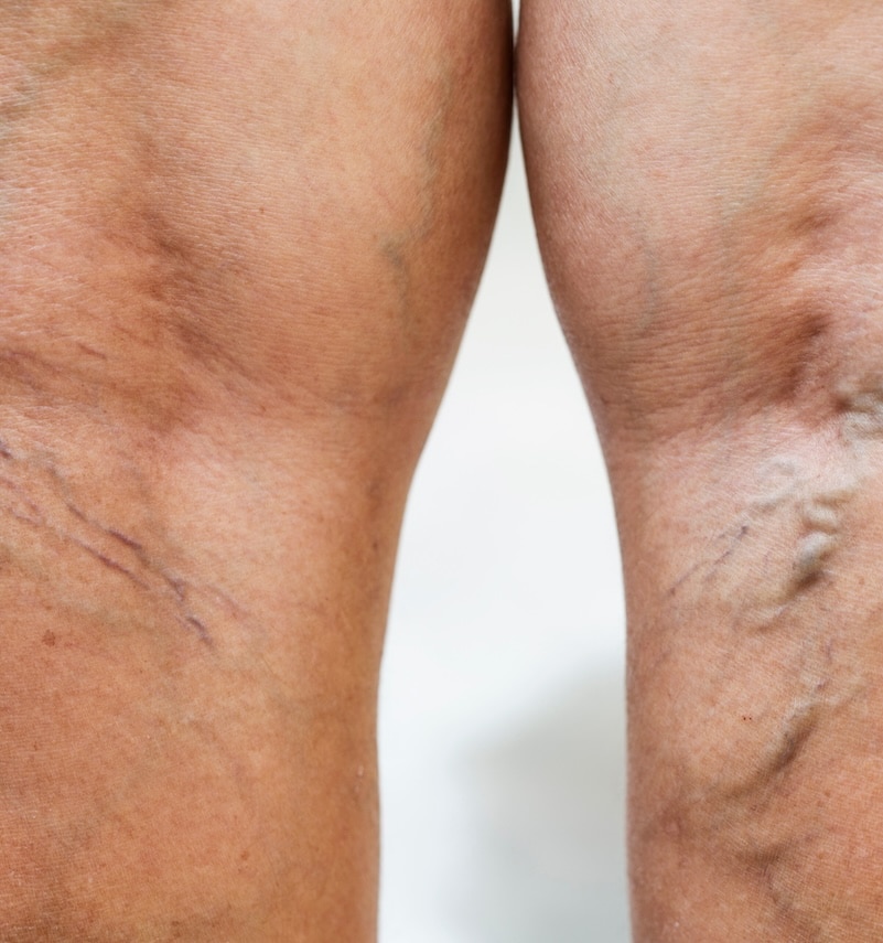 elderly legs with prominent veins elderly legs with prominent veins