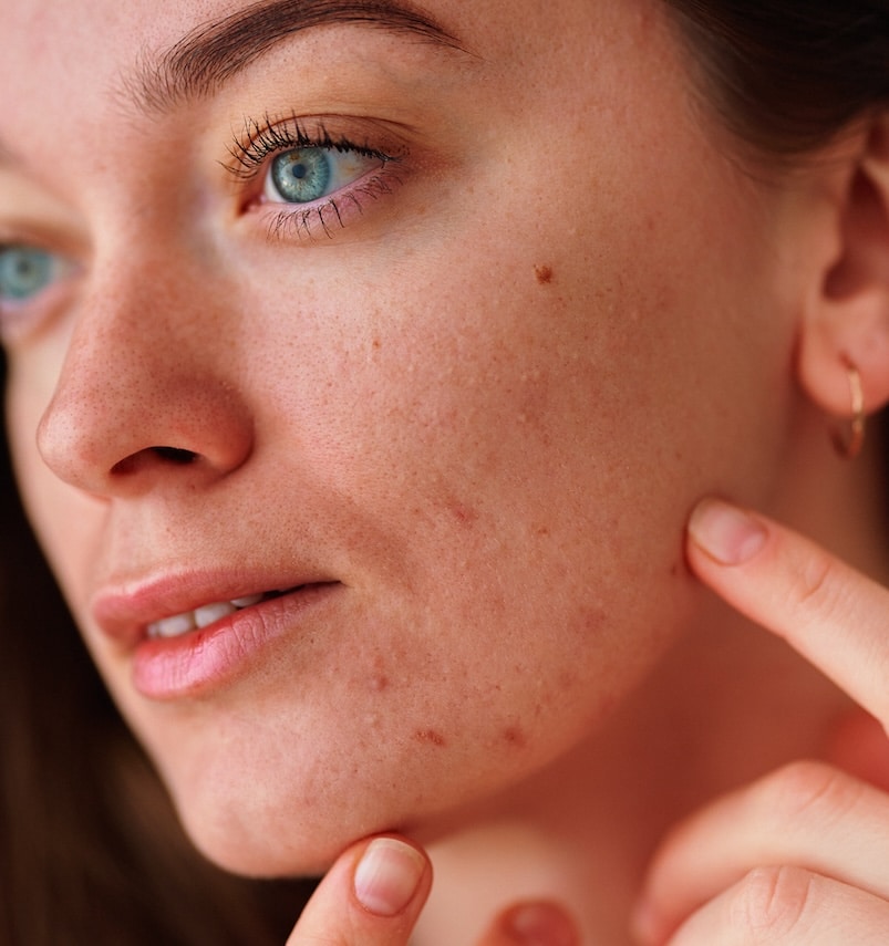 woman with acne woman with acne