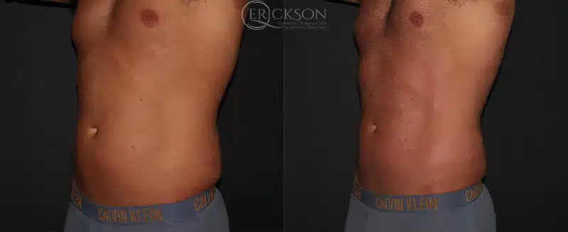 Photo of man’s abdomen before Emsculpt treatment