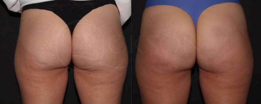 cellulite-reduction-before-and-after-photo