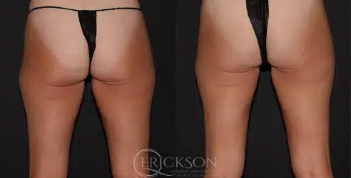 Photo showing woman’s legs before Sofwave™