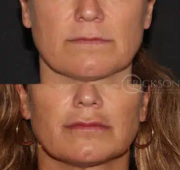 Photo showing wrinkles before dermal fillers