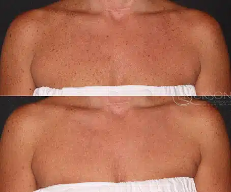 Photo of woman’s chest before BBL treatment