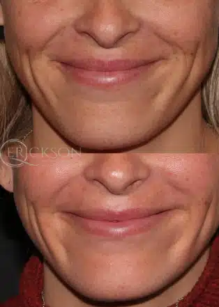 Photo showing volume loss before dermal fillers