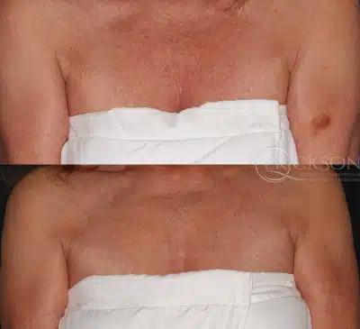 Photo of woman’s chest before Ultherapy treatment
