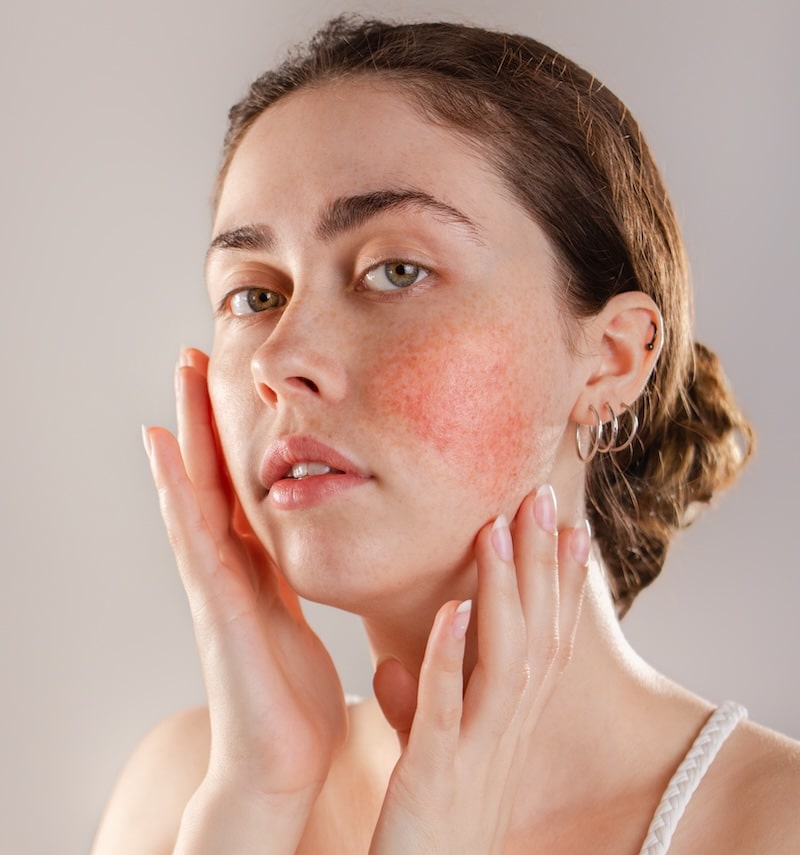 woman with rosacea woman with rosacea