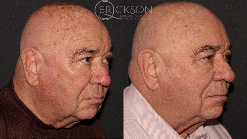 Close-up of man’s brown sun spots before Forever Young BBL
