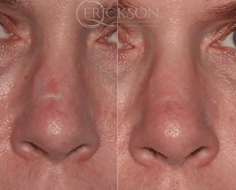 Close-up photo before nasal contouring