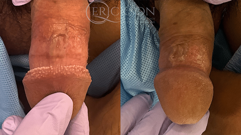 PPP Removal Before and After Photo by Dr. Erickson in Chicago, IL