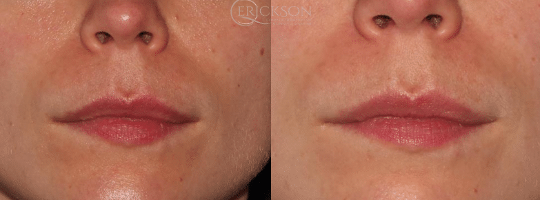Photo of smile lines before PRP injections