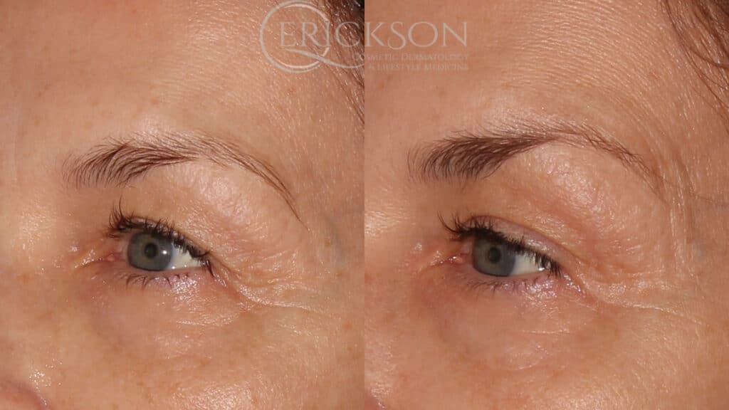 Photo of woman’s eyes before Sofwave™ treatment