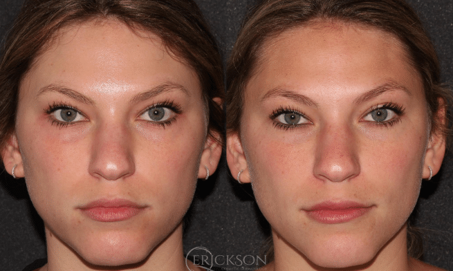 Photo of patient before Vampire Facelift