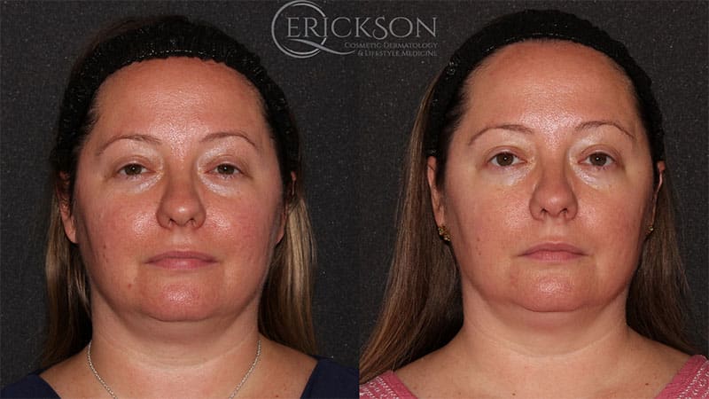 Facial photo before ClearSilk® treatment
