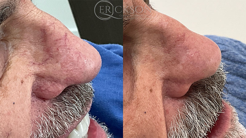 Face before ClearV® treatment