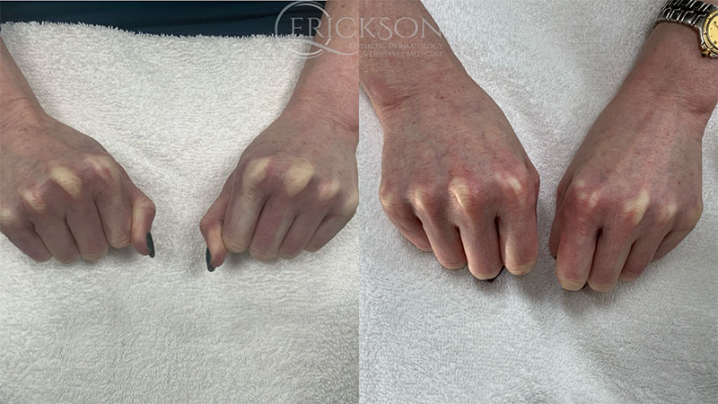 Hand photo before ClearSilk® treatment