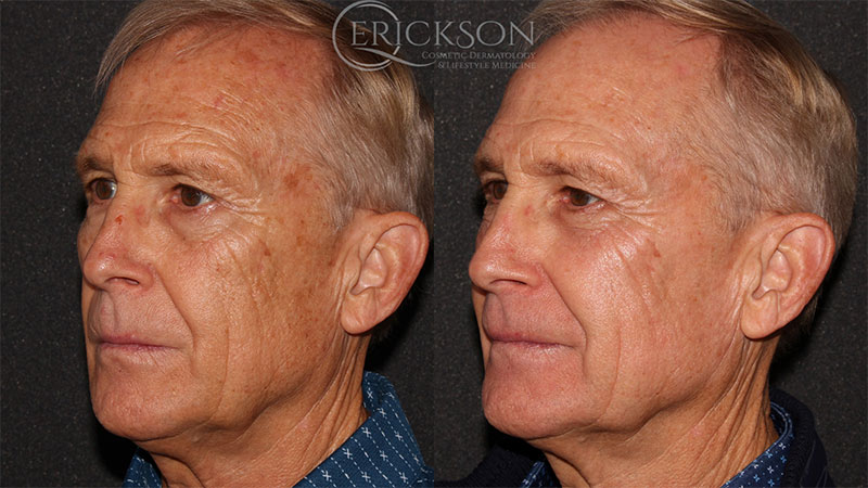 Side view photo of older man before HALO® treatment