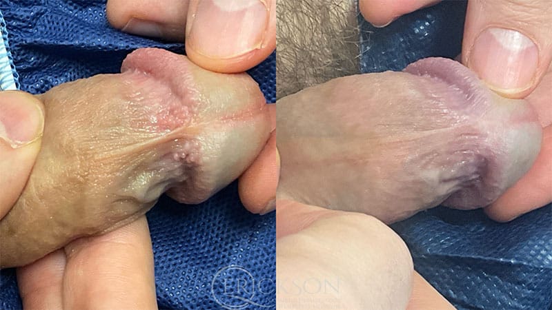PPL Removal Before and After Photo by Dr. Erickson in Chicago, IL