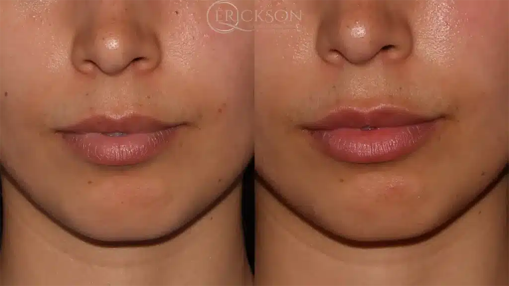 Photo of lips before dermal fillers