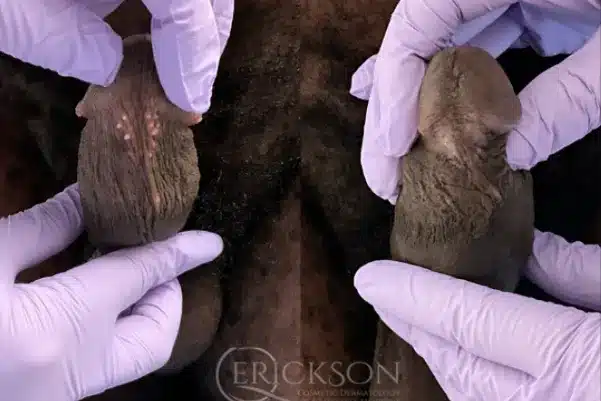 PPP Pearly Penile Papules Removal Before and After Photo by Dr. Erickson in Chicago IL