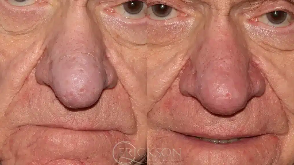 Patient photo before nasal contouring