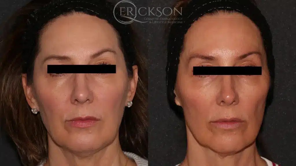 Close-up photo of woman before Sofwave™ session