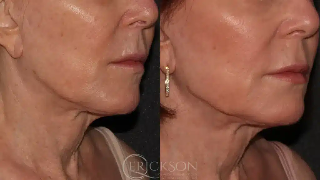 Side angle photo of woman before Sofwave™ session