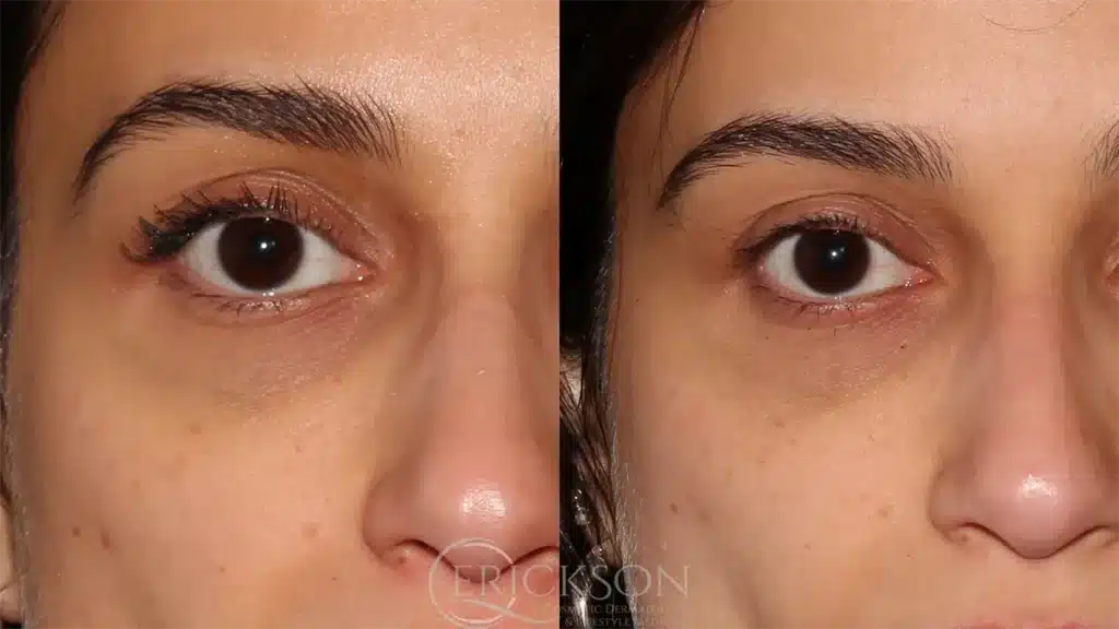 Facial photo before ClearV®