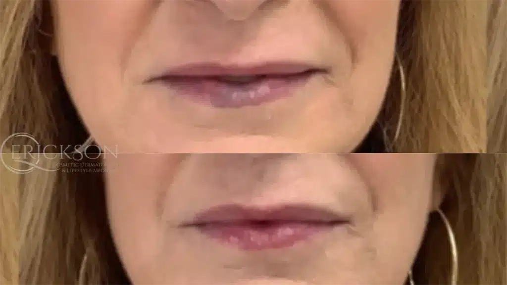 Uneven skin photo before ClearV®