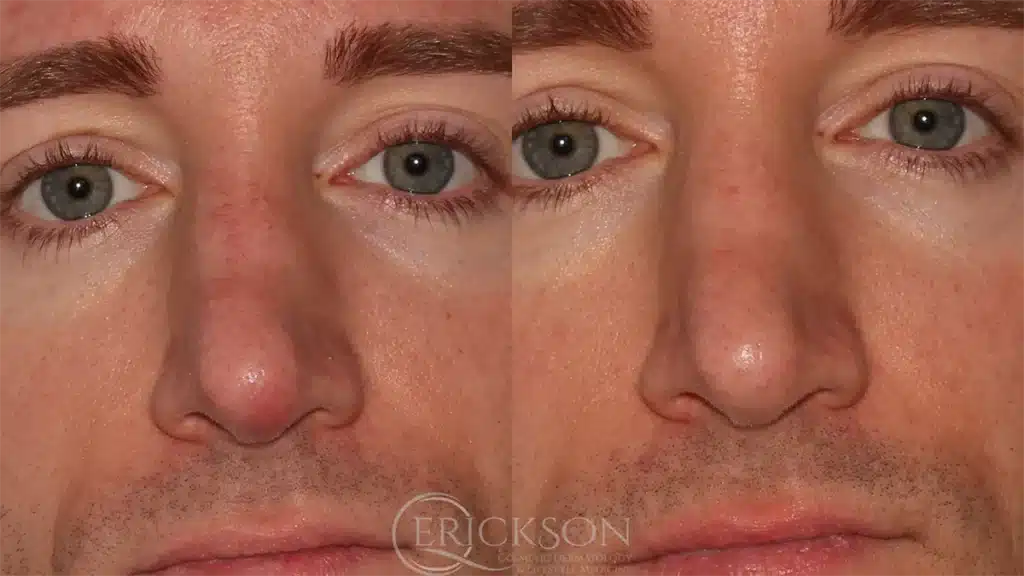 Patient photo before ClearV®