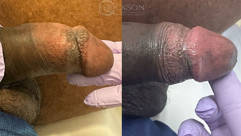 Patient photo before PPP removal treatment