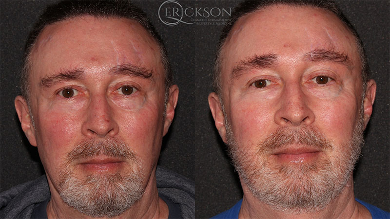 Man’s face with rosacea before Forever Young BBL