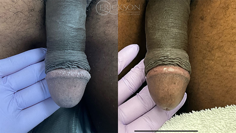 PPP Removal Before and After Photo by Dr. Erickson in Chicago, IL