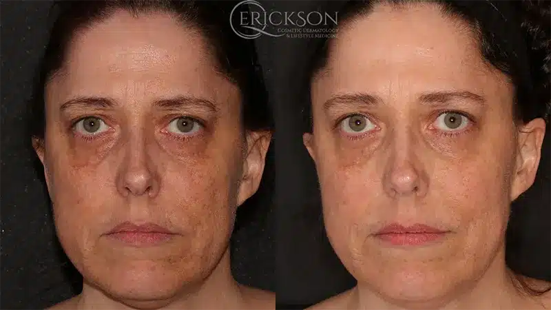 BBL Chemical Peel Before and After Photo by Dr. Erickson in Chicago, IL