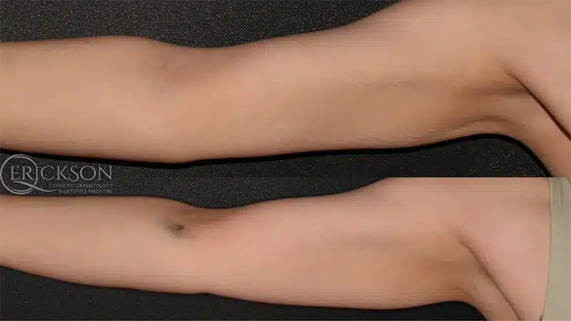 Secret™ RF Series Before and After Photo by Dr. Erickson in Chicago, IL