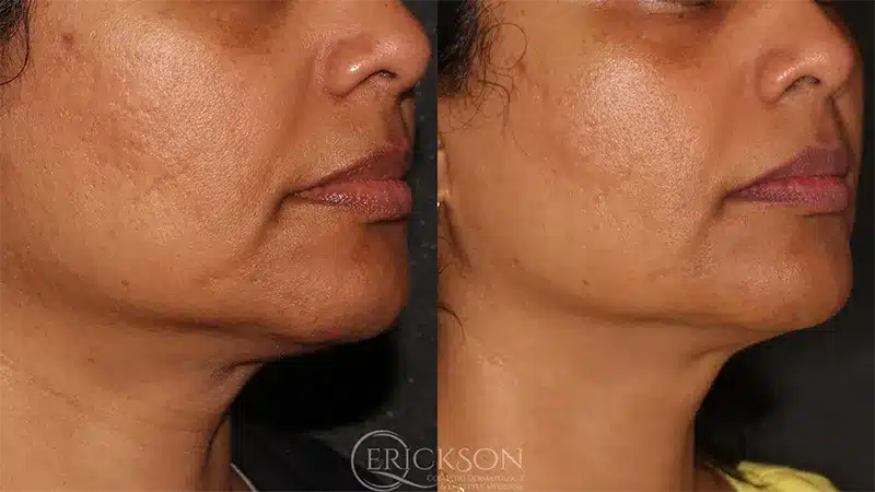Secret™ RF Series Before and After Photo by Dr. Erickson in Chicago, IL