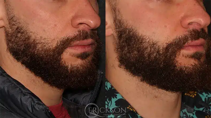 Secret™ RF Series Before and After Photo by Dr. Erickson in Chicago, IL