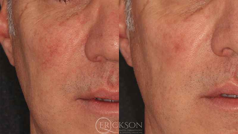 ClearV Before and After Photo by Dr. Erickson in Chicago, IL