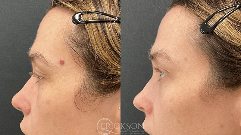 ClearV Before and After Photo by Dr. Erickson in Chicago, IL