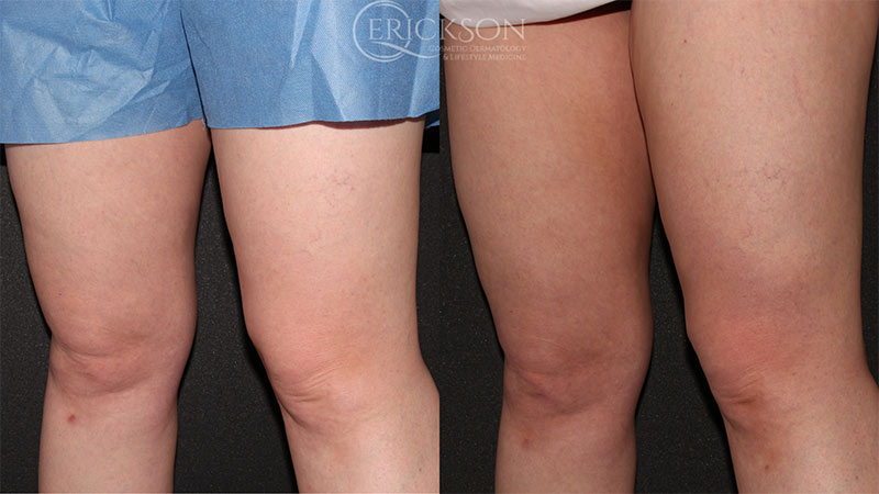 Coolsculpt Before and After Photo by Dr. Erickson in Chicago, IL
