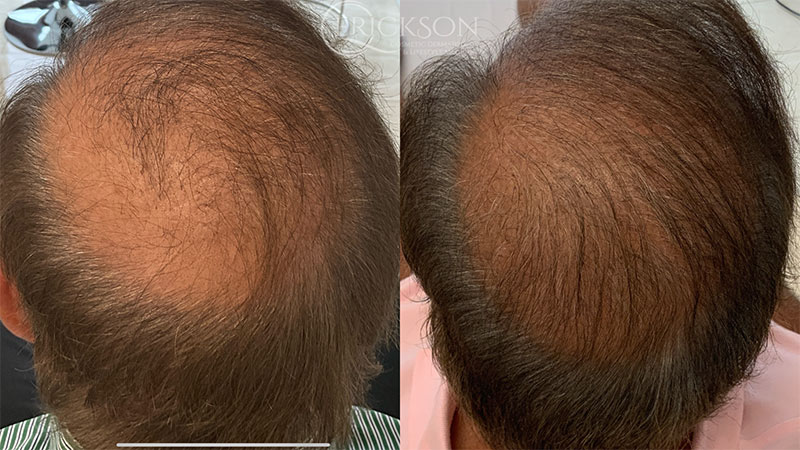 Hair Restoration Before and After Photo by Dr. Erickson in Chicago, IL